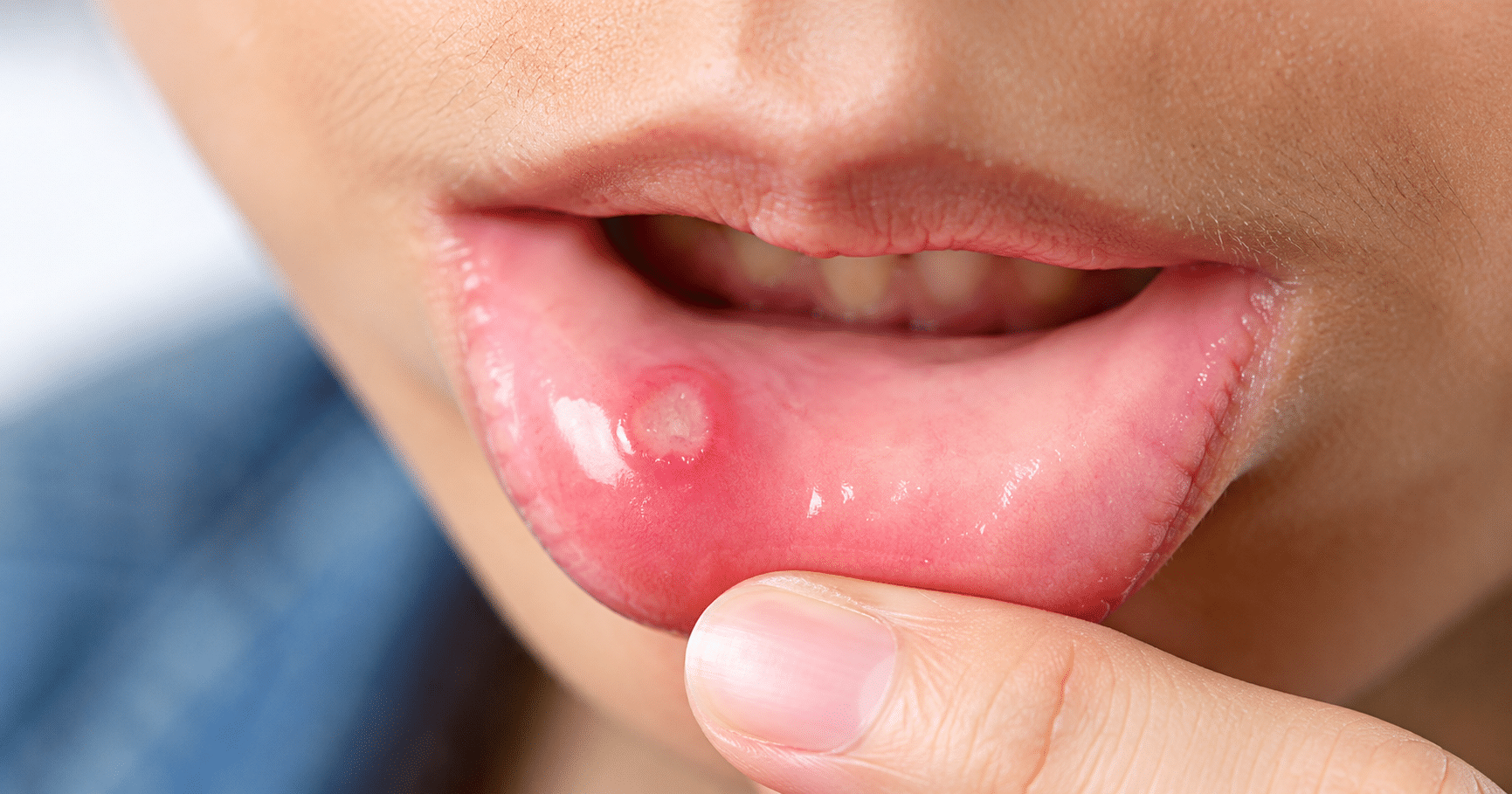 5 sinais na boca que podem indicar diabetes